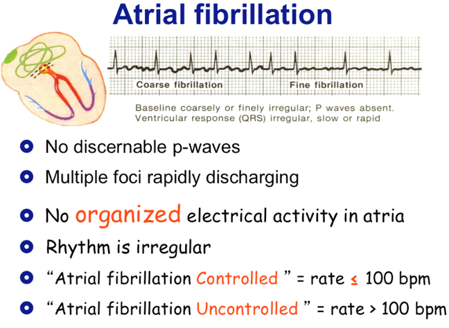 atrial flutter vs a fib