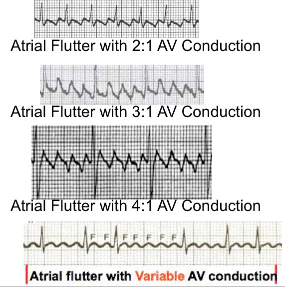 atrial fibrillation vs atrial flutter