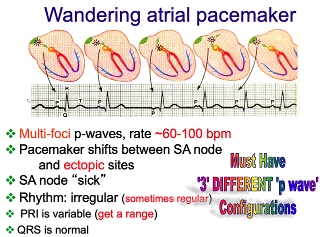 wandering pacemaker vs multifocal atrial tachycardia